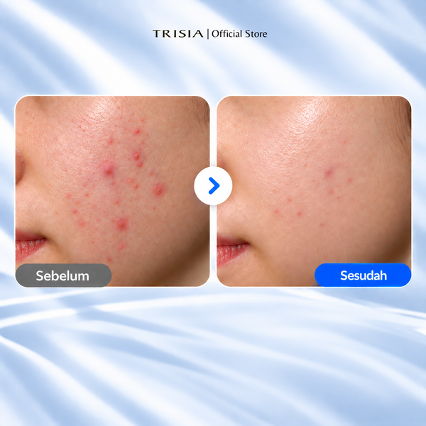 Sophora Anti Acne Spot Gel